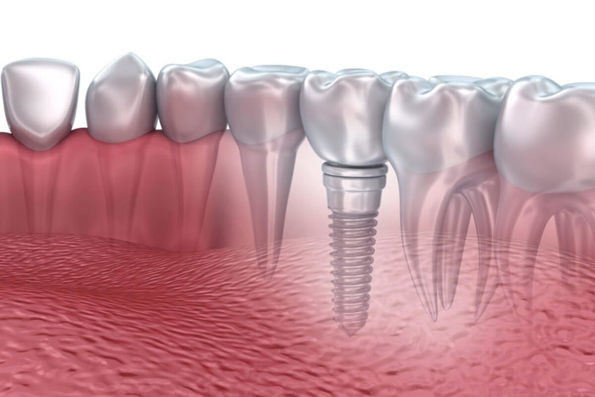 Cấy ghép Implant là kỹ thuật sử dụng 1 loại vít có kích thước nhỏ như chân răng và cấy trực tiếp vào trong xương hàm