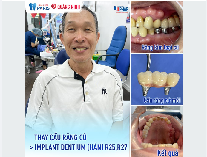 Muốn đảm bảo ăn nhai tốt phải chọn răng sứ tốt và implant tốt!