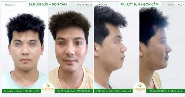 Không phải cứ đàn ông là phải mũi L-line mới đẹp.