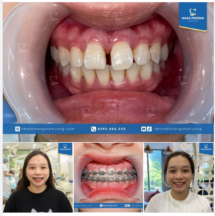 Sau khoảng 6 tháng, khe thưa trên răng Thanh Huyền đã biến mất không còn dấu vết. Không chỉ vậy, răng được dàn đều trên cung hàm giúp bạn có nụ cười tự tin hơn rất nhiều.