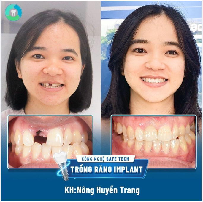 KHÔI PHỤC RĂNG CỬA - THẨM MỸ HOÀN HẢO NHƯ RĂNG THẬT