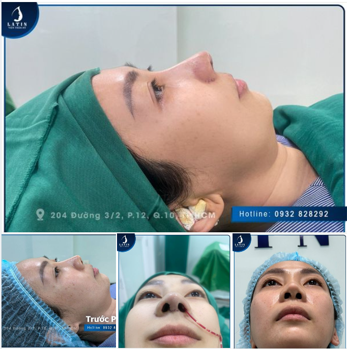 Ca mũi sửa lại xuất sắc hôm nay