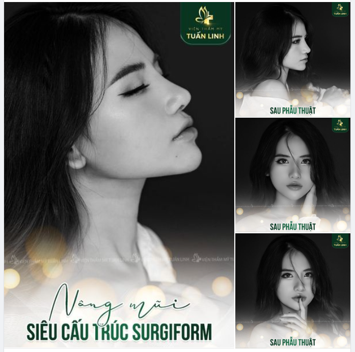 Cô nàng P.N trước đây đã từng rất tự ti với chiếc mũi thấp tẹt, cánh mũi to bè. Nhưng bạn không dám nâng mũi vì sợ không được như mong muốn và lỡ có biến chứng về sau.
