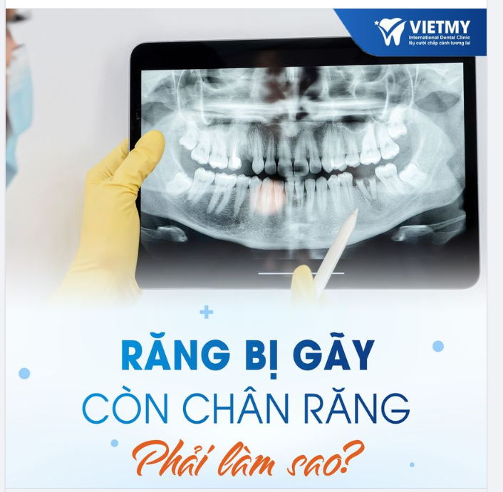 MẤT RĂNG NHƯNG CÒN CHÂN RĂNG PHẢI XỬ LÍ NHƯ THẾ NÀO ??