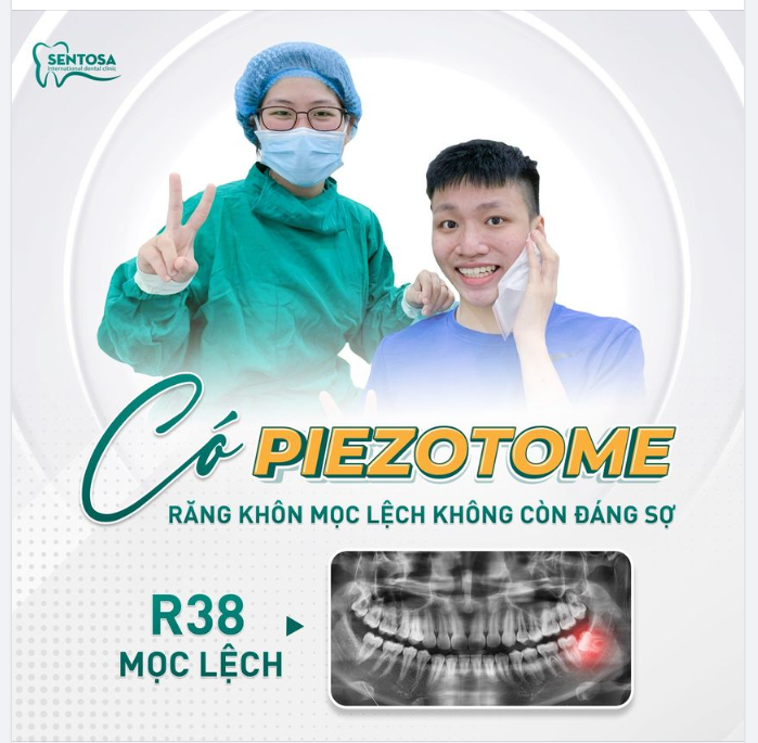 CÓ PIEZOTOME RĂNG KHÔN MỌC LỆCH KHÔNG CÒN ĐÁNG SỢ