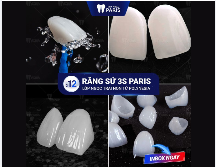Mẫu răng sứ được ưa chuộng nhất tại Paris!