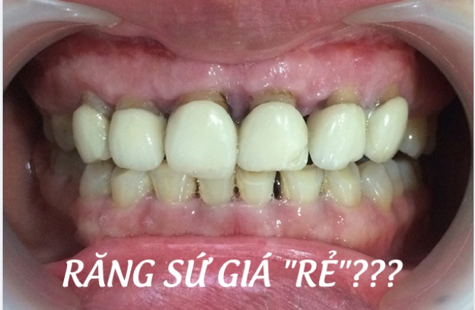 RĂNG SỨ GIÁ RẺ - LIỆU CÓ "RẺ" THẬT KHÔNG???