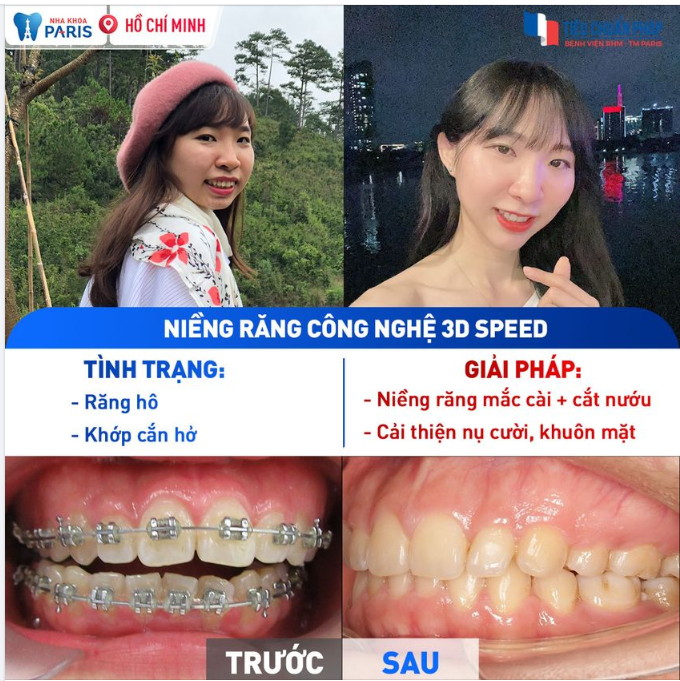 Đừng để hàm răng khiến bạn mất tự tin thể hiện bản thân.