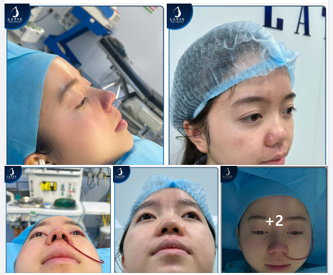 Mũi cấu trúc lên dáng tự nhiên cho em gái
