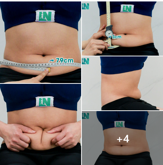  HÚT MỠ TẠO DÁNG THẨM MỸ CHO CHỊ KH 9X ĐẾN TỪ ĐỒNG NAI. LỰA CHỌN LÀM ĐẸP AN TOÀN, KHÔNG MUỐN CAN THIỆP CĂNG DA BỤNG. 