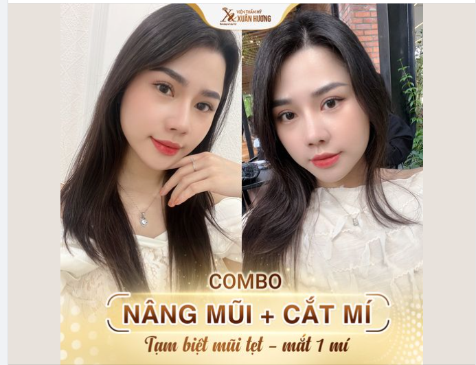 Xem ngay kết quả combo nâng mũi + cắt mí dưới đây, nếu không muốn phải hối hận
