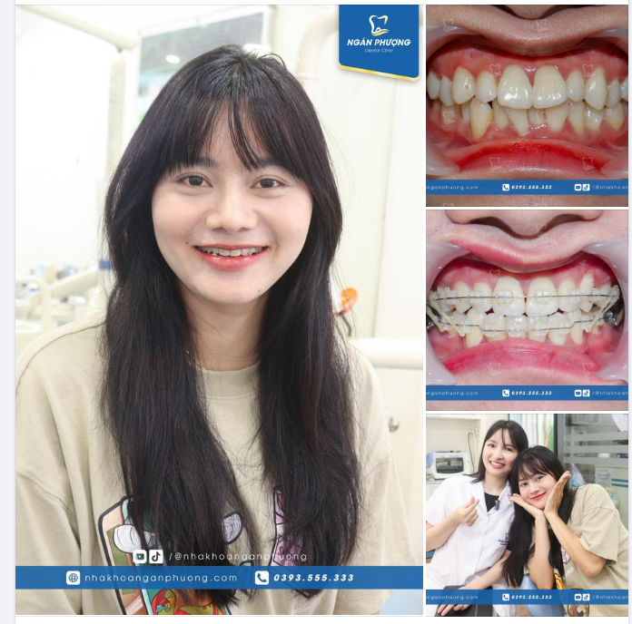 Hiii, Tiểu Ngáo niềng răng thế nào rồi?