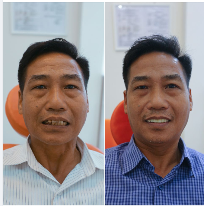 CẬN CẢNH QUÁ TRÌNH PHỤC HÌNH RĂNG HÀM TRÊN TẠI NHA KHOA QUỐC TẾ VIỆT MỸ