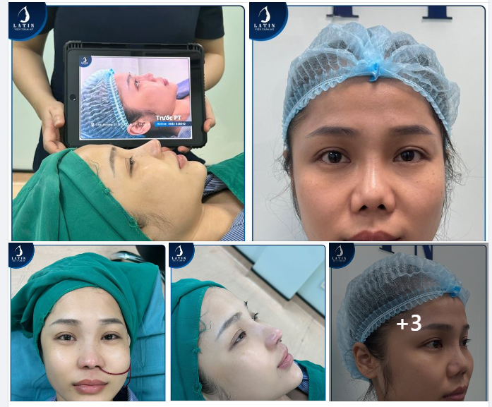 Chị gái Hà Nội: Chọn sai nơi làm đẹp, mũi cũ biến chứng co rút nghiêm trọng.