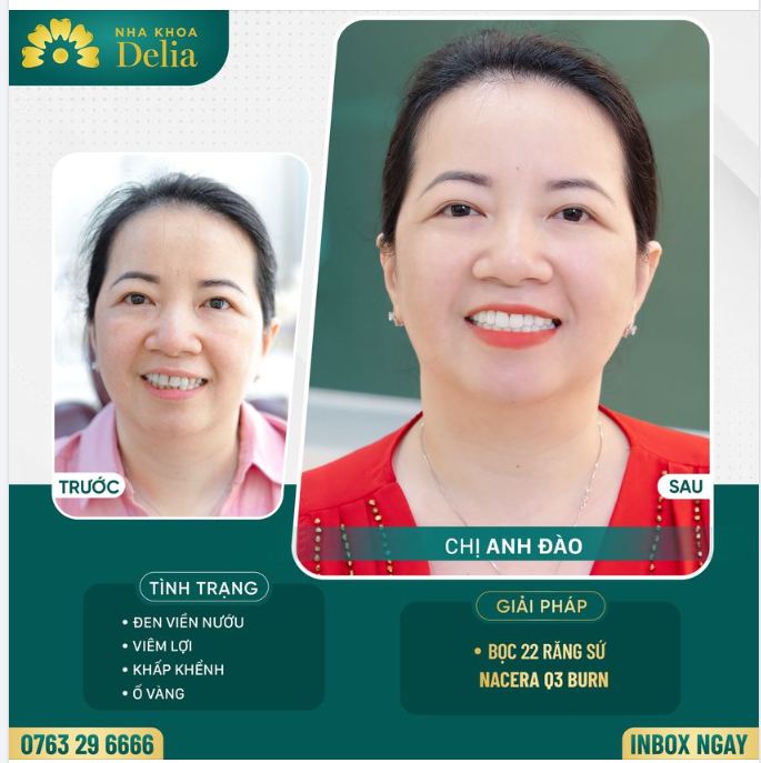 Cùng Delia xem lại những thay đổi mà nụ cười mới đã mang lại cho chị Đào nhé!