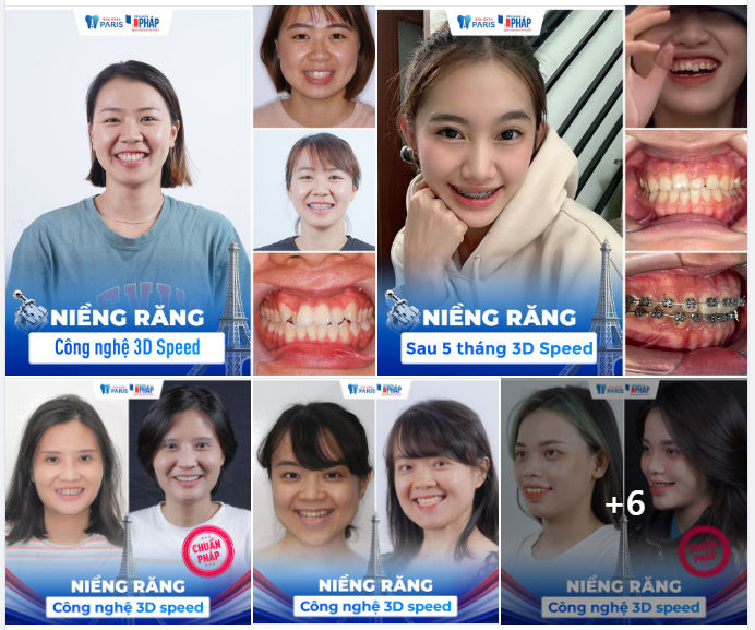 Kiên trì niềng 1-2 năm đổi lại được thành quả xứng đáng!