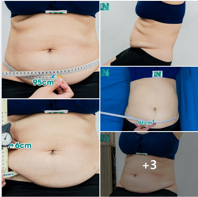  HÚT MỠ TẠO DÁNG THẨM MỸ CHO CHỊ KH CÓ CƠ ĐỊA SẸO LỒI, KHÔNG MUỐN CAN THIỆP PHẪU THUẬT CĂNG DA.