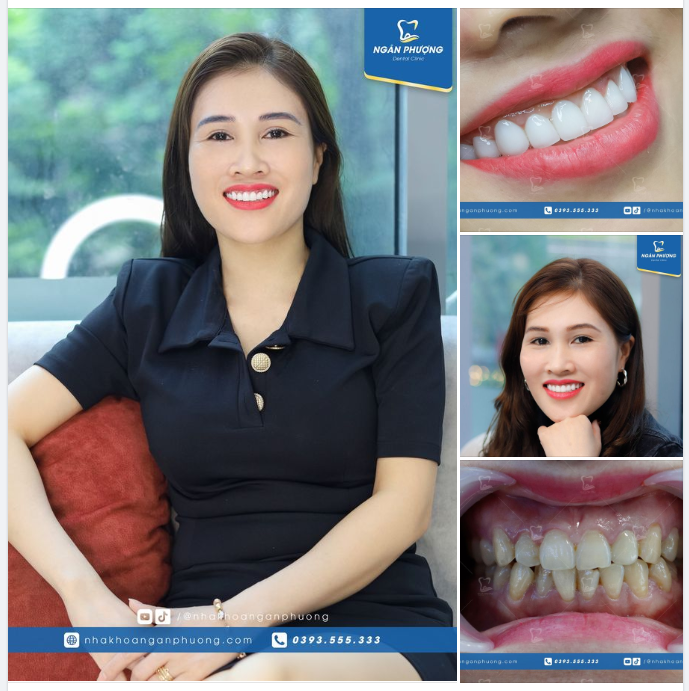 Nhìn bức hình đầu tiên, có ai nghĩ đây là răng sứ sau nhiều năm tái khám không ạ?