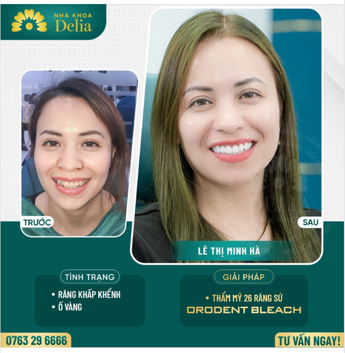 Cùng Delia xem lại những thay đổi bất ngờ mà nụ cười răng sứ mới đã mang lại cho cho chị Hà nhé!