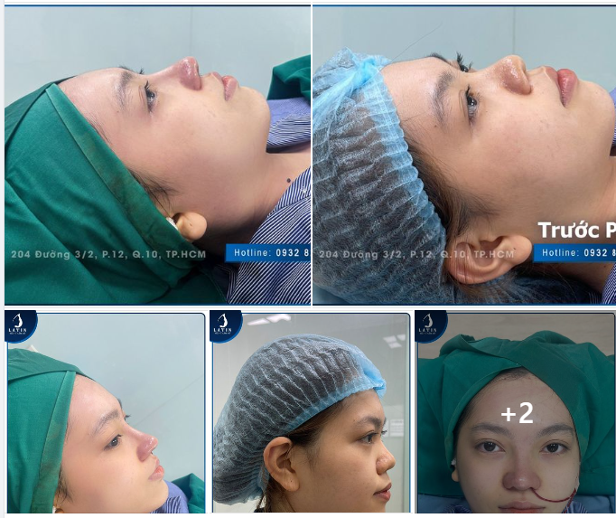 Mũi cấu trúc cho em gái lần đầu nâng mũi