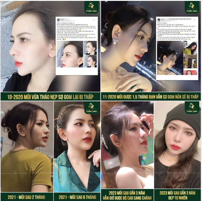 Bạn nào vừa nâng mũi xong SỢ BỊ THẤP thì tham khảo ngay pic này nha!!