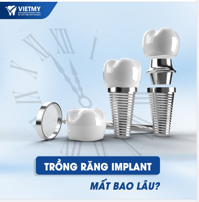 TRỒNG RĂNG IMPLANT MẤT BAO LÂU ?