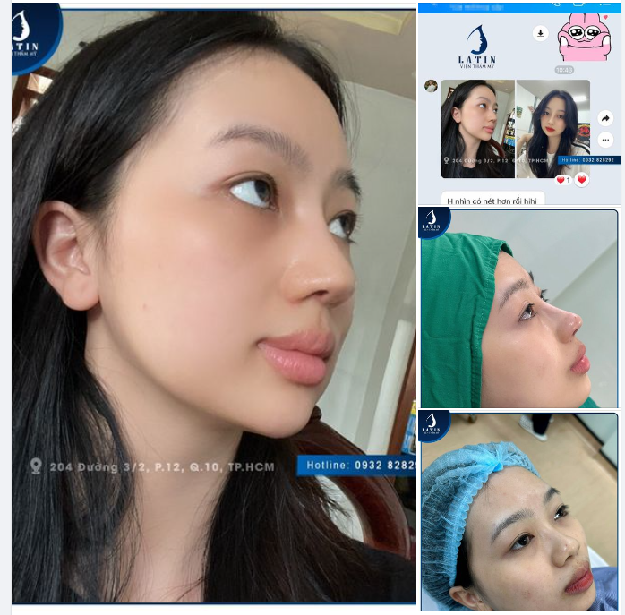 Nhan sắc chạm đỉnh sau 20 ngày nâng mũi