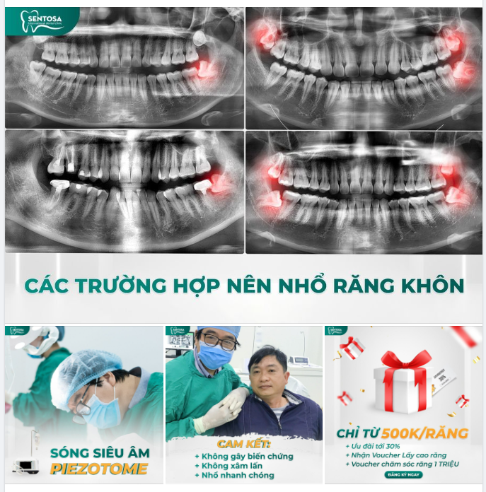 TIẾT KIỆM ĐẾN 30% KHI NHỔ RĂNG KHÔN TẠI SENTOSA
