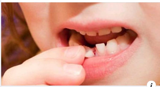 Trẻ thay răng sớm phải “đối mặt” những nguy cơ gì? Bạn nên làm thế nào?