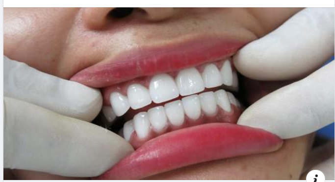 Cảm giác sau khi bọc răng sứ: Những điều bất thường cần lưu ý