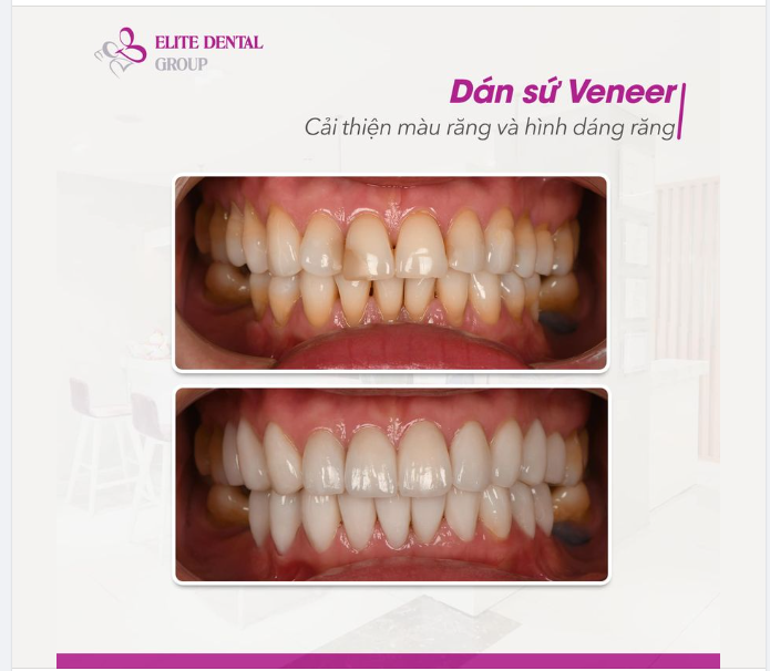 Cải thiện màu răng và hình dáng răng nhờ mặt dán sứ Veneer