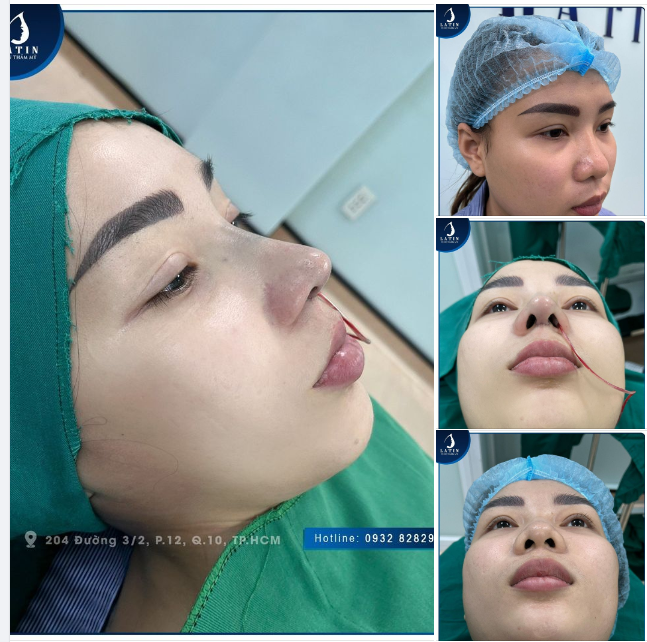 Mũi cấu trúc Surgiform - Lựa chọn hàng đầu cho chị em nâng mũi