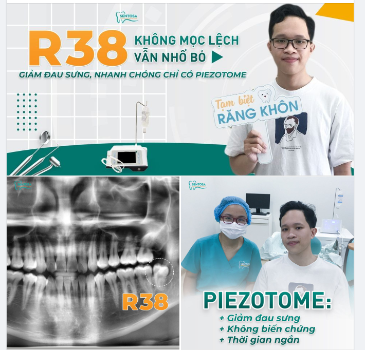R38 KHÔNG MỌC LỆCH VẪN NHỔ BỎ