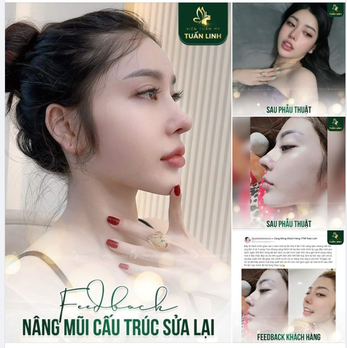 Chia sẻ của khách hàng đã từng 4 lần sửa mũi không ưng ý