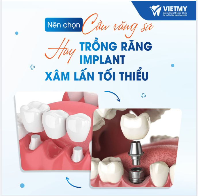 Cầu Răng Hay Răng Implant - Lựa Chọn Hợp Nhất Cho Nụ Cười Tươi Sáng