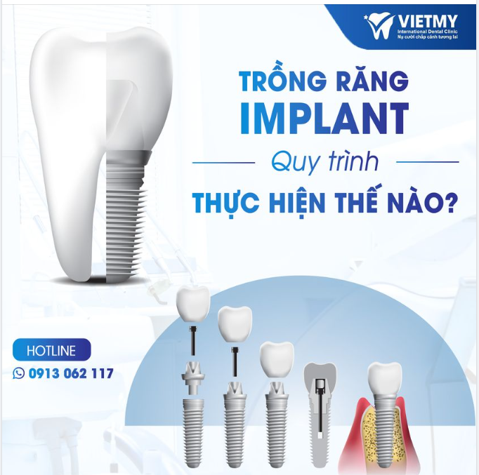 QUY TRÌNH TRỒNG RĂNG IMPLANT CHUẨN Y KHOA ĐƯỢC THỰC HIỆN NHƯ THẾ NÀO????