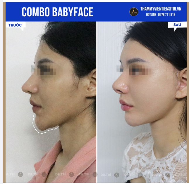 COMBO BABYFACE- BÍ MẬT ĐẰNG SAU NHỮNG GƯƠNG MẶT ĐẸP BABY