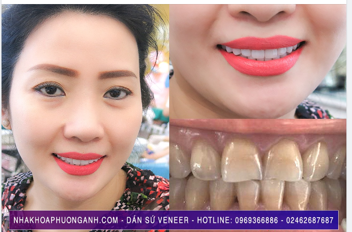 19 Thói quen làm hỏng răng của bạn
