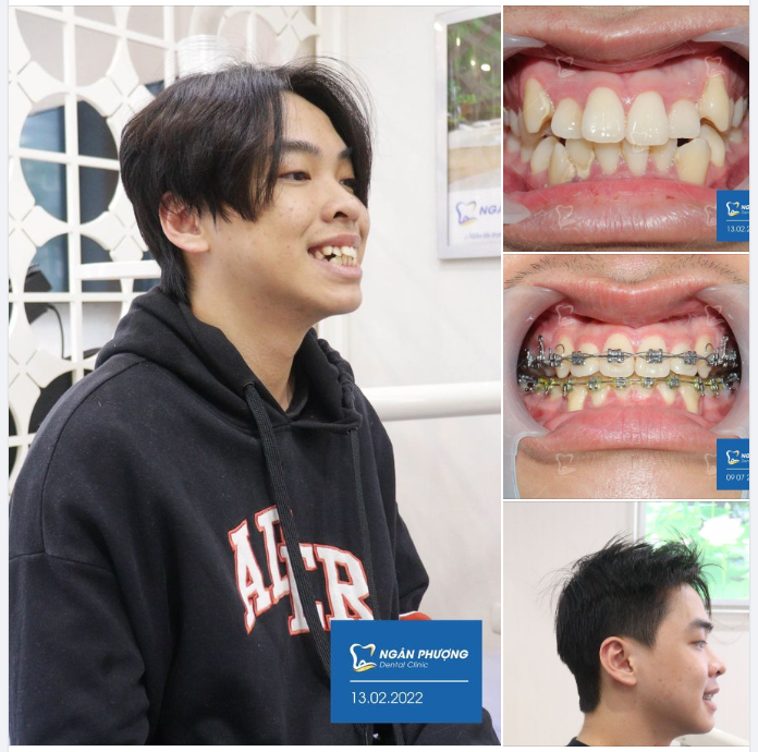 Hoàng Duy niềng răng đã được 1 năm. Với tình trạng hô, khấp khểnh nhiều, Duy chưa được tự tin về cả nụ cười lẫn khuôn mặt mình.