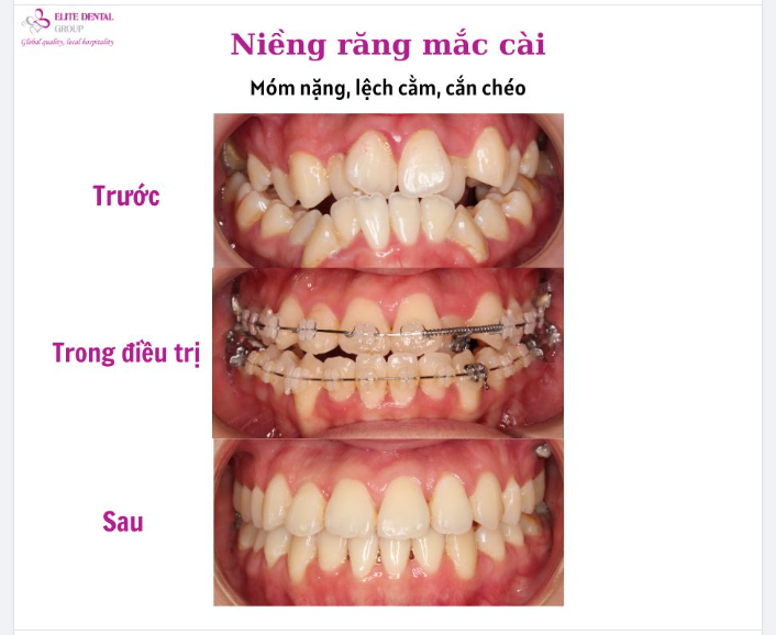 Tình trạng ban đầu: Móm xương, cằm quá triển. Răng cắn chéo răng sau, đường giữa lệch. Răng mọc lệch lạc, chen chúc nhiều