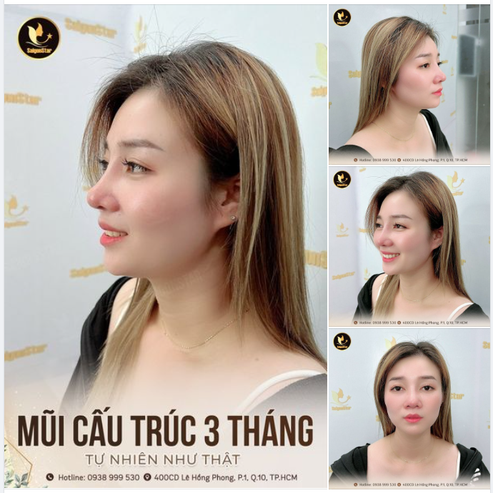 3 THÁNG MŨI CẤU TRÚC – ĐẸP TỰ NHIÊN NHƯ THẬT