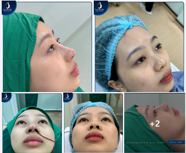 Một chiếc mũi mới làm xong lên dáng xuất sắc