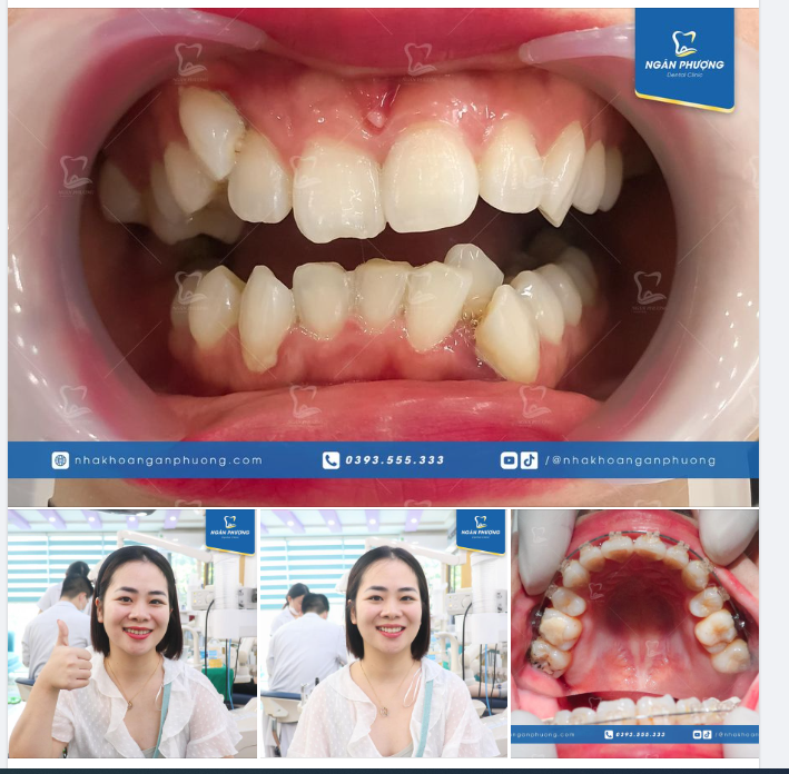 Chúc mừng  Khánh Linh đã được tháo niềng rồi