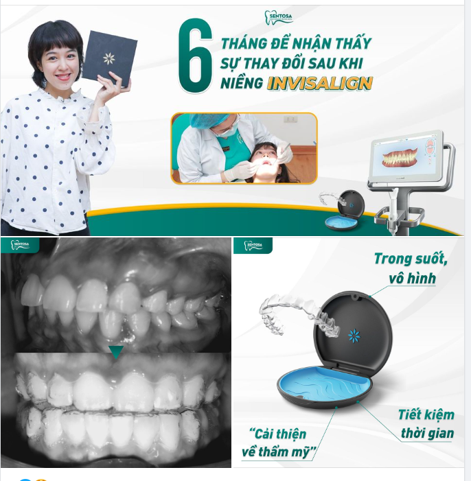 6 THÁNG ĐỂ NHẬN THẤY SỰ THAY ĐỔI SAU KHI NIỀNG INVISALIGN