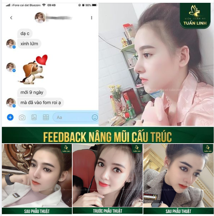 Dáng mũi Angel Line cao bay, cánh mũi thon gọn, sống mũi thẳng có độ lượn mềm mại tự nhiên khiến gương mặt trở nên khả ái hơn, xinh đẹp hơn và ''tây'' hơn!!