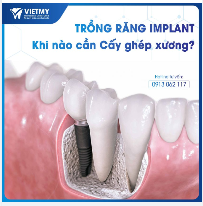 TRỒNG RĂNG IMPLANT, KHI NÀO CẦN CẤY GHÉP XƯƠNG ?