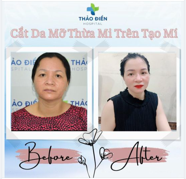 CẮT MÍ TỰ NHIÊN TAN BIẾN ƯU PHIỀN