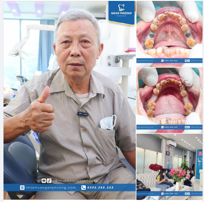 "Giờ thì thấy trong miệng hơi vướng chứ không đau hay bị sao cả. Bác sĩ Giang làm rất mát tay." - Chú Quang Phục chia sẻ sau khi trồng 2 cây implant răng hàm.