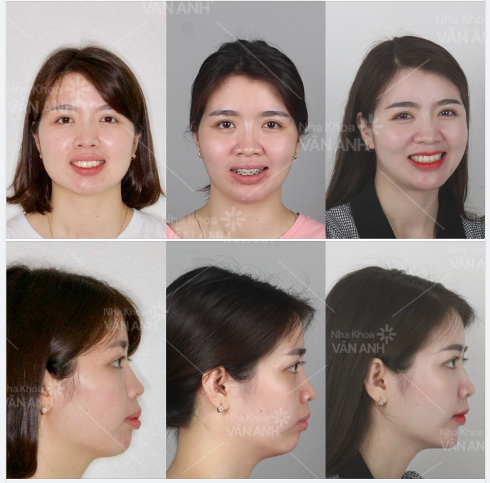 BYE BYE MẮC CÀI - CƯỜI XINH HẾT CỠ