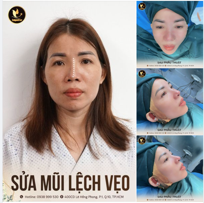 SỬA MŨI LỆCH VẸO 60 PHÚT CAO THẲNG SANG CHẢNH